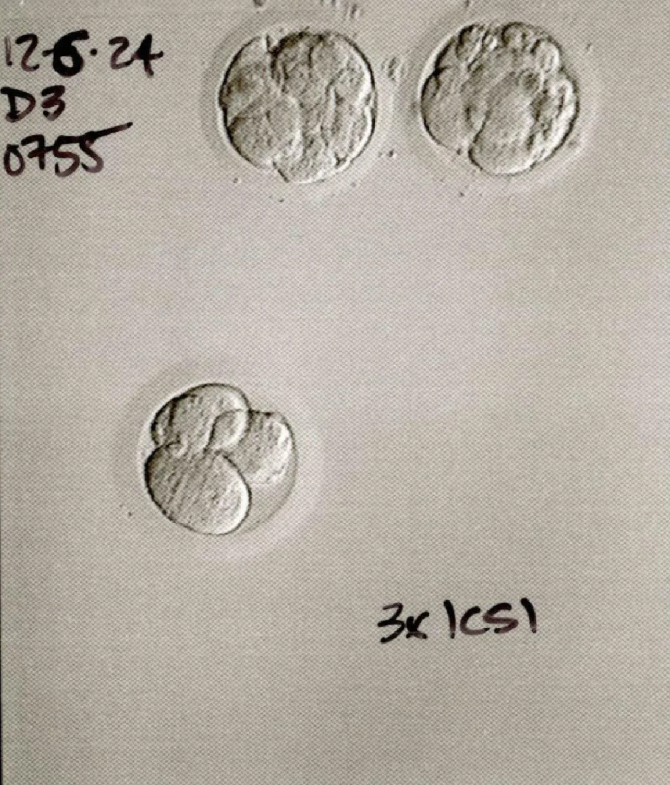 Frozen embryo transfer 1